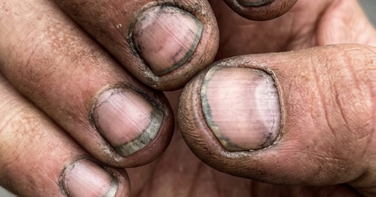 Comment appelle-t-on une personne qui a des ongles comme ça ?