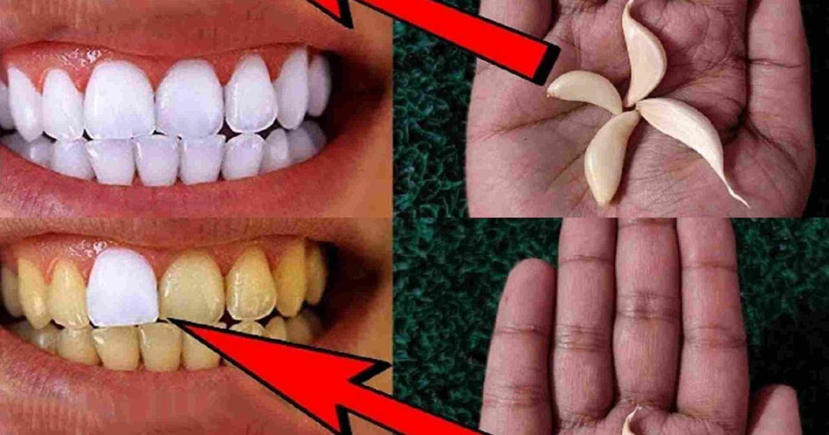 Comment utiliser l’ail pour blanchir les dents ?