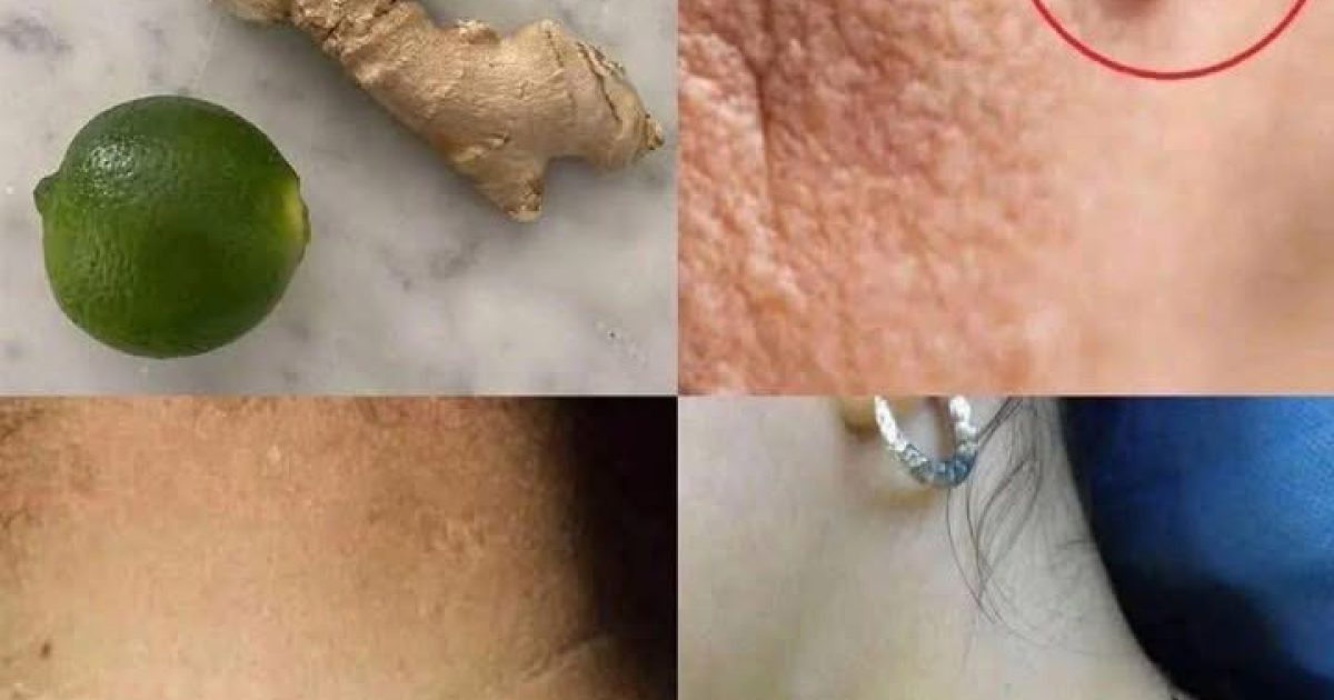 Comment éliminer les boutons et verrues ?