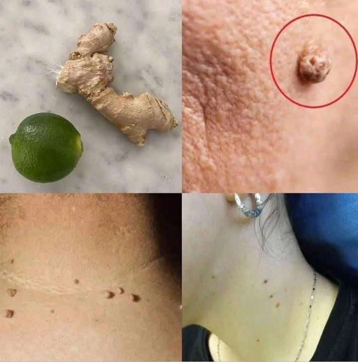 Comment éliminer les boutons et verrues ?