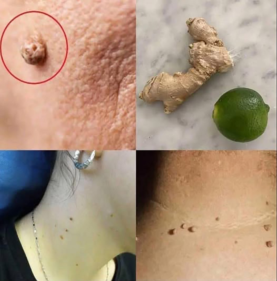 Comment éliminer une verrue efficacement ?