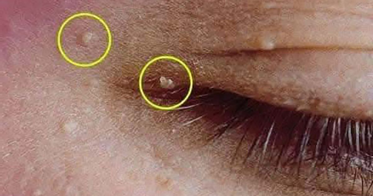 Kystes de milium : découvrez comment les faire disparaître efficacement