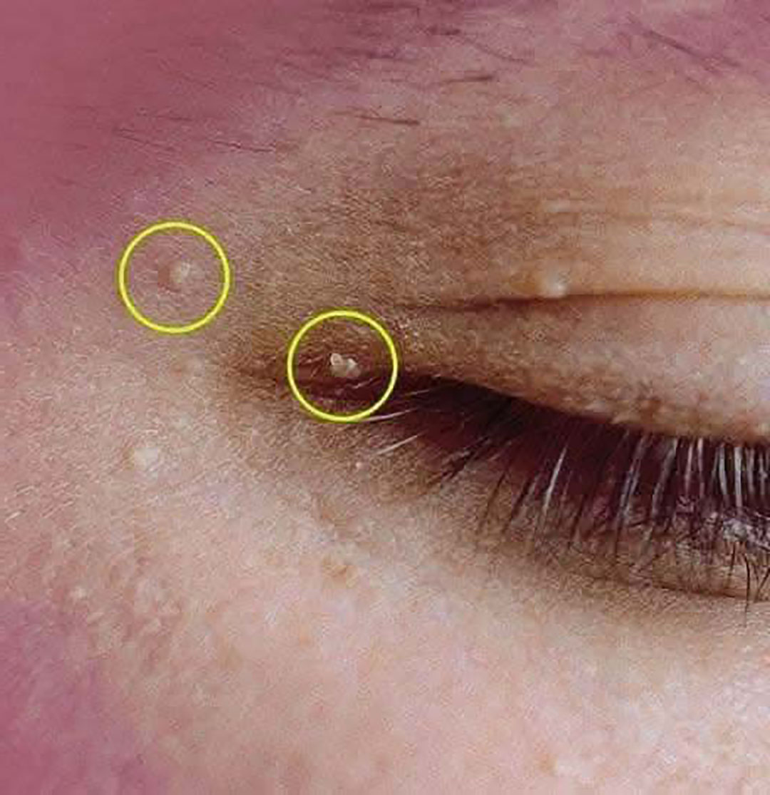 Kystes de milium : découvrez comment les faire disparaître efficacement