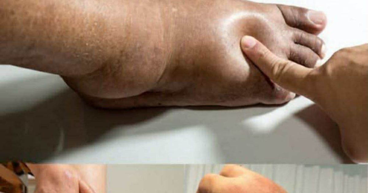 Comment soulager le gonflement des mains et des pieds ?