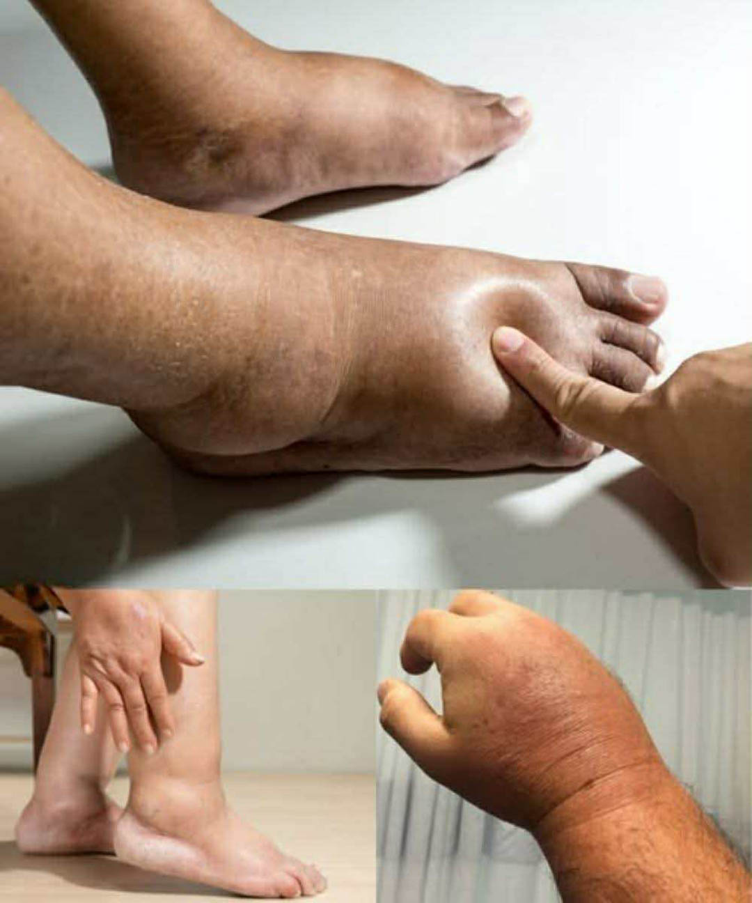 Comment soulager le gonflement des mains et des pieds ?