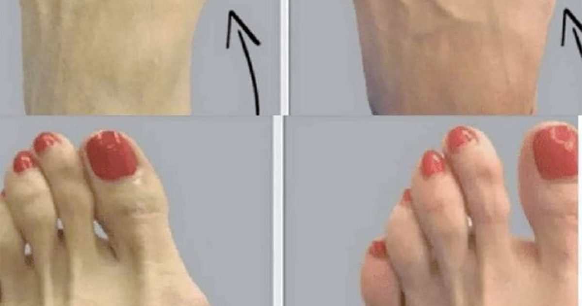 Comment soulager naturellement l’hallux valgus (aussi appelé oignon du pied) ?