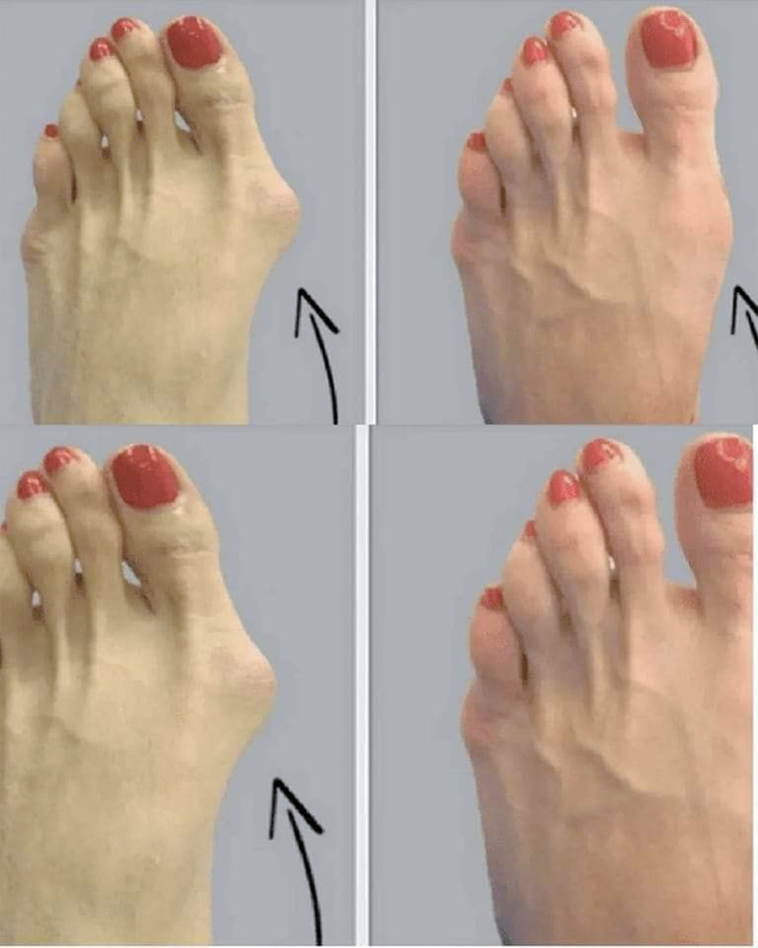 Comment soulager naturellement l’hallux valgus (aussi appelé oignon du pied) ?