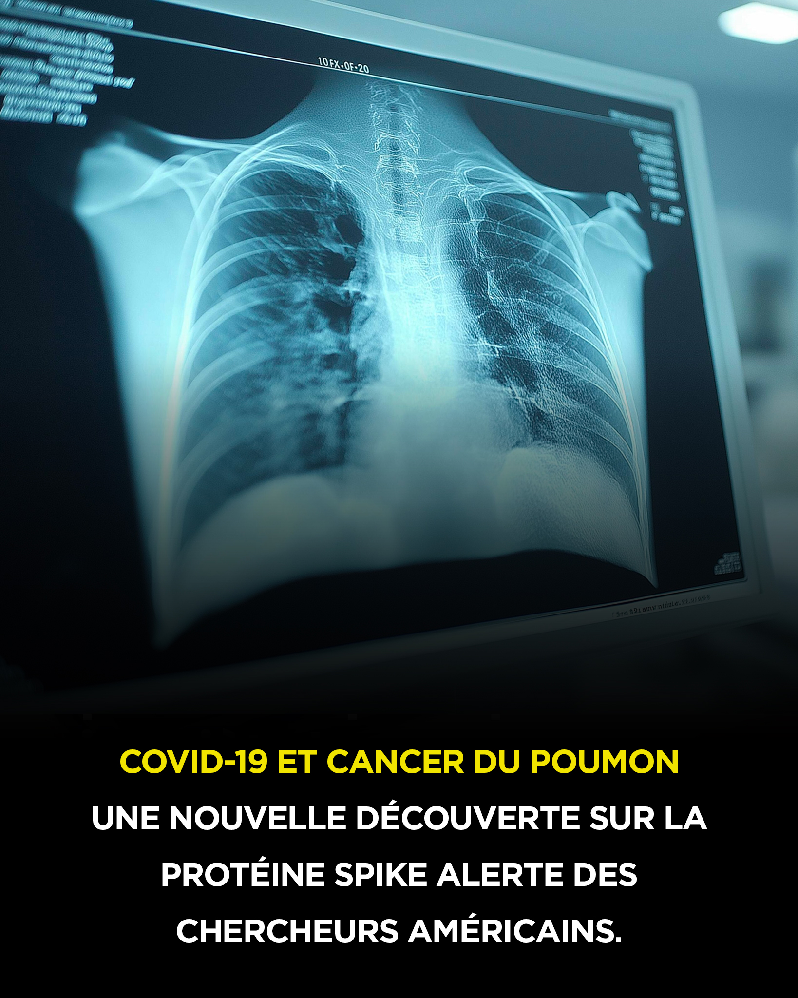 Covid-19 et cancer du poumon : une découverte sur la protéine Spike suscite l’inquiétude de chercheurs américains