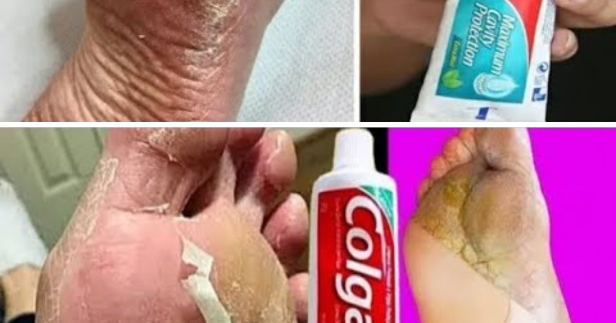 Découvrez l'astuce surprenante avec du Colgate pour des pieds plus doux