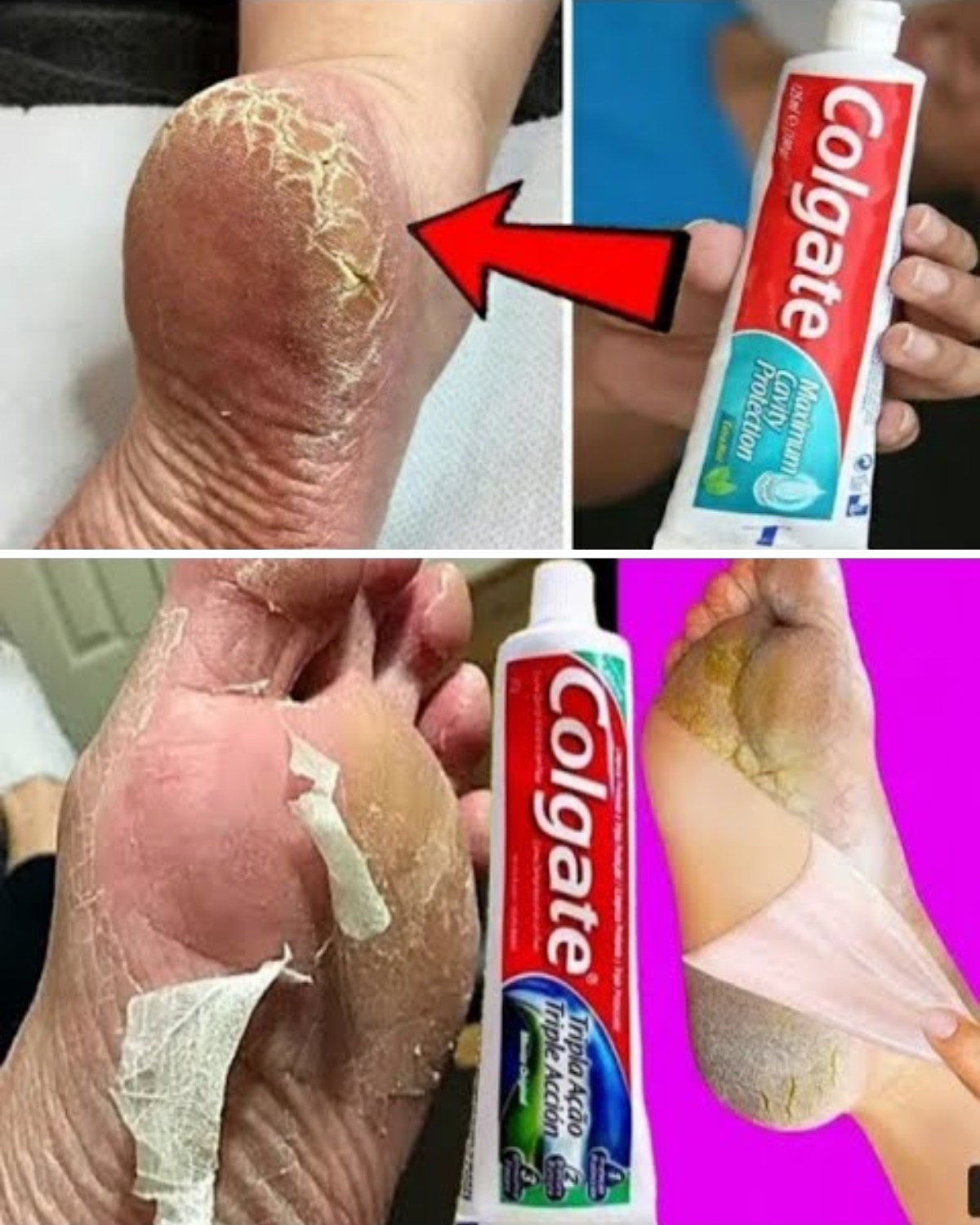 Découvrez l'astuce surprenante avec du Colgate pour des pieds plus doux
