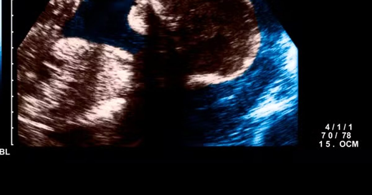 Des scientifiques ont peut-être découvert l’une des causes de l’autisme