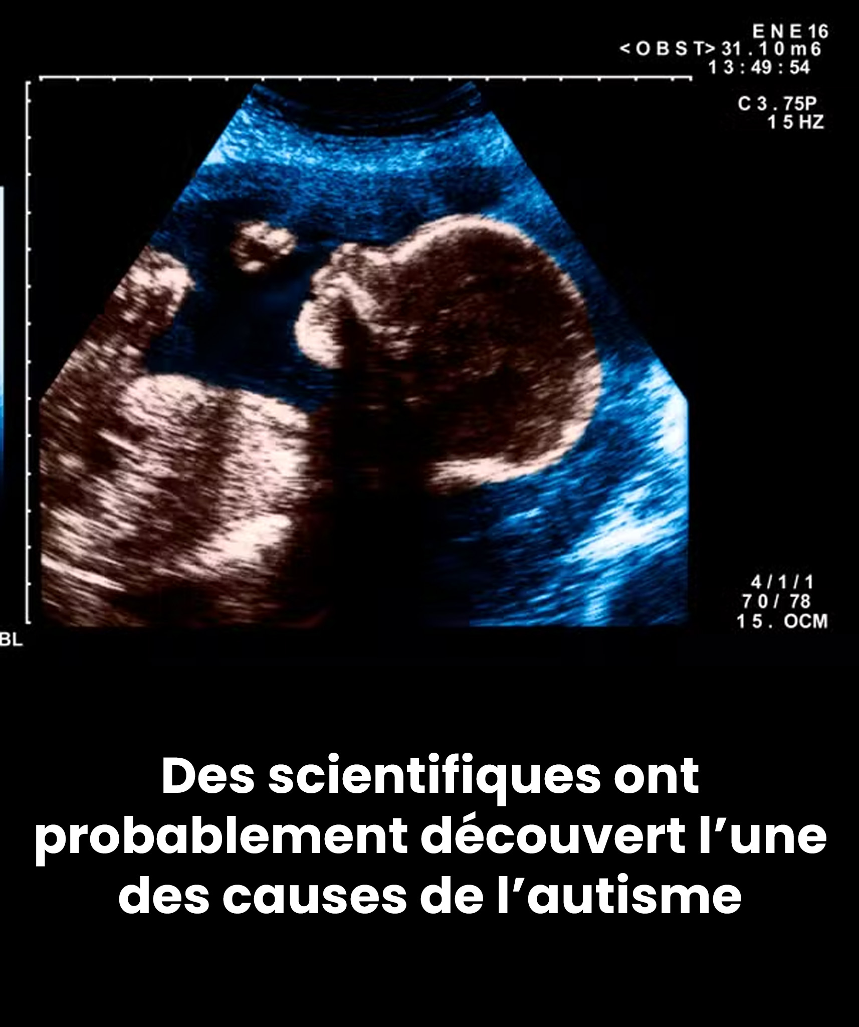 Des scientifiques ont peut-être découvert l’une des causes de l’autisme