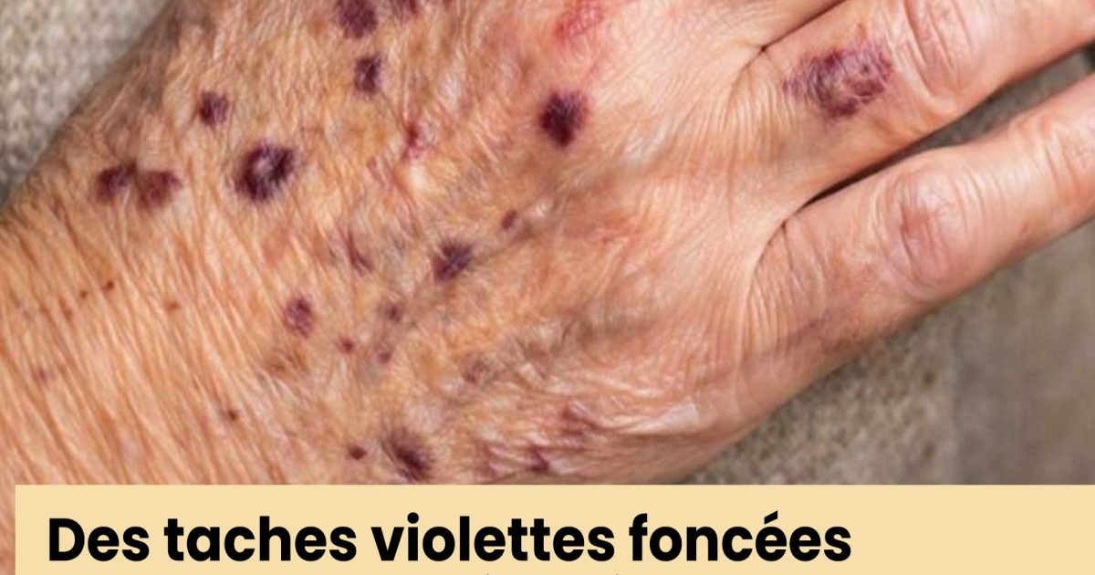 Des taches violet foncé apparaissent régulièrement sur mes mains, et mon rendez-vous chez le médecin est dans plusieurs semaines. Que dois-je faire en attendant ?
