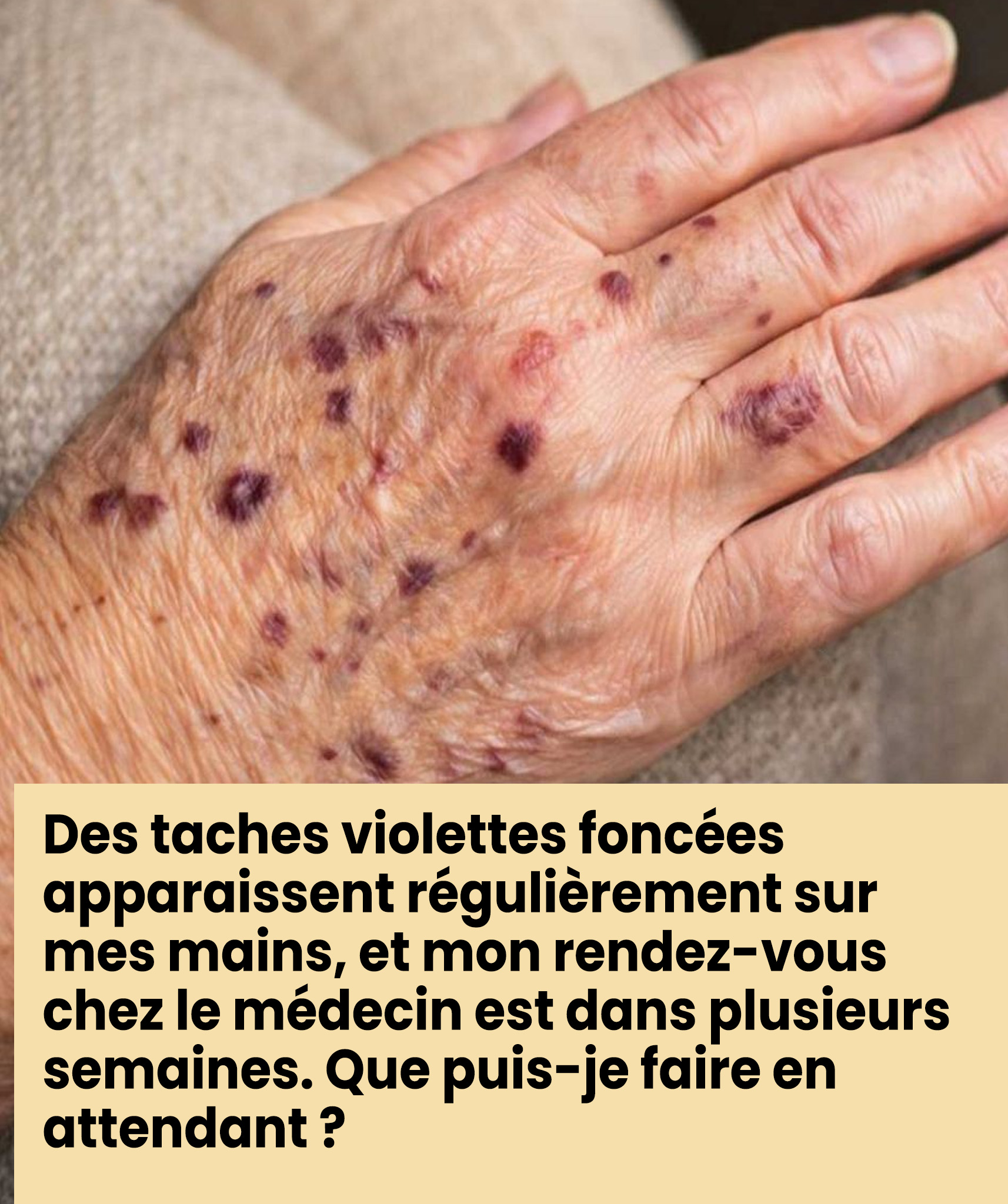 Des taches violet foncé apparaissent régulièrement sur mes mains, et mon rendez-vous chez le médecin est dans plusieurs semaines. Que dois-je faire en attendant ?