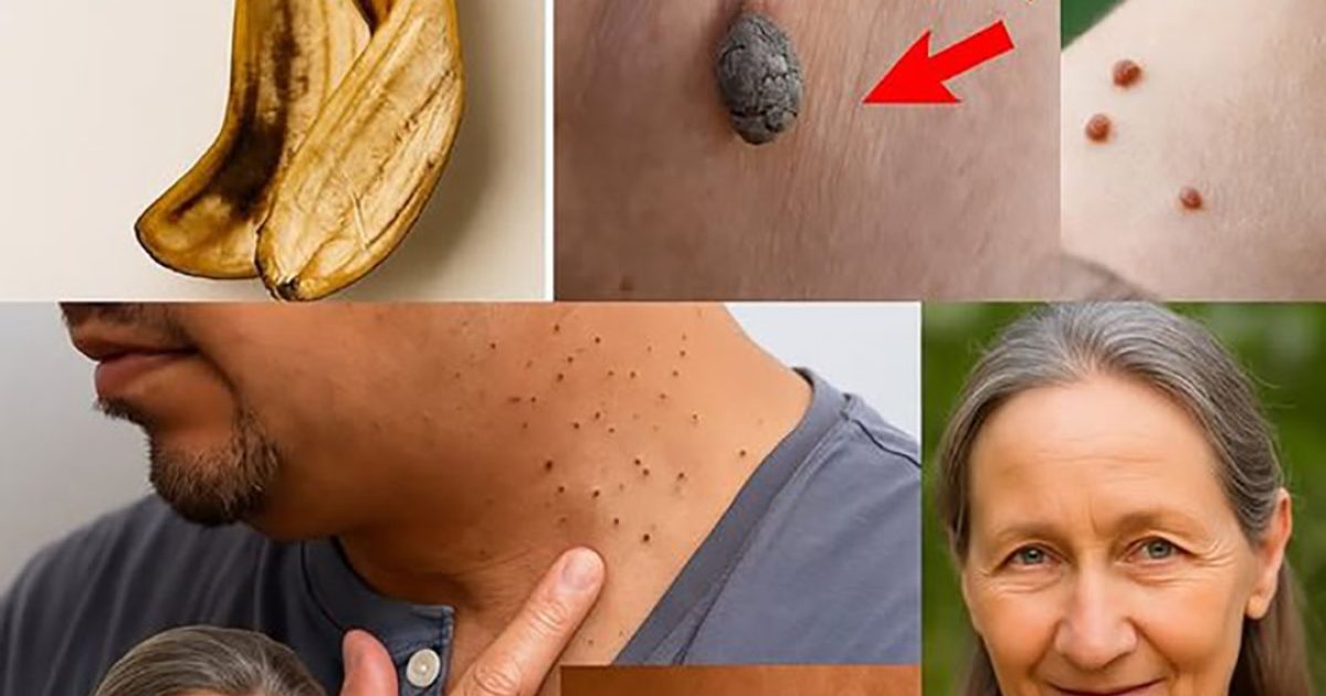 Dites adieu aux acrochordons du visage grâce à la peau de banane
