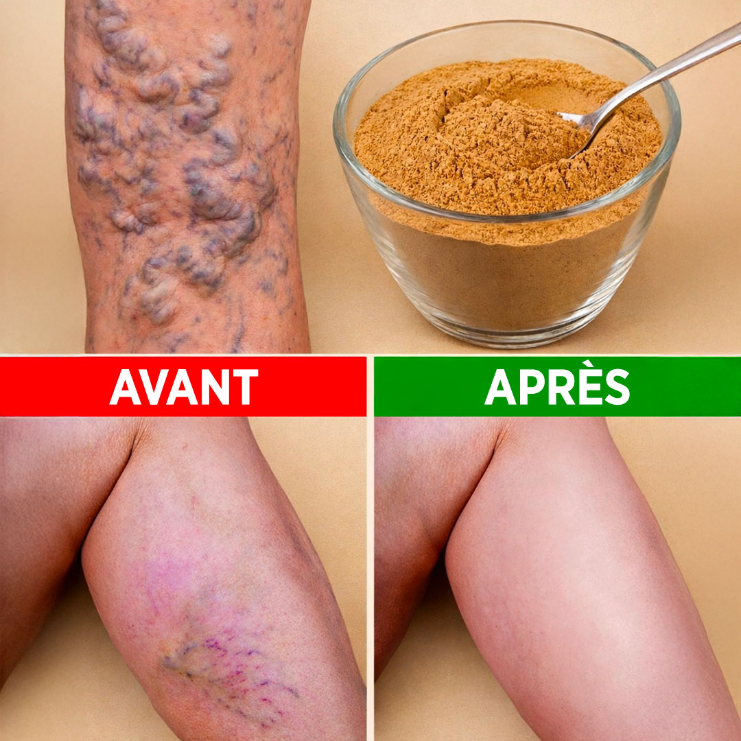Dites adieu aux varices naturellement : un remède simple à base d’ail, d’oignon et d’huile d’olive qui pourrait vous soulager