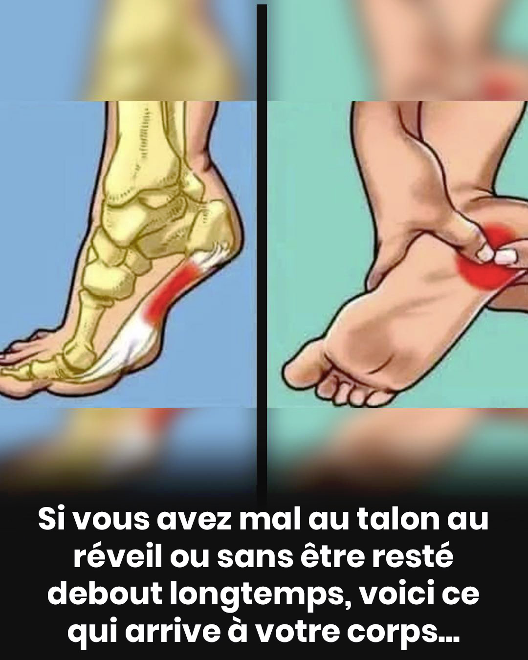Douleur au talon : les causes les plus courantes et le rôle de la fasciite plantaire