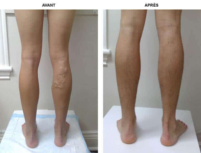 Produits pharmaceutiques pour les jambes