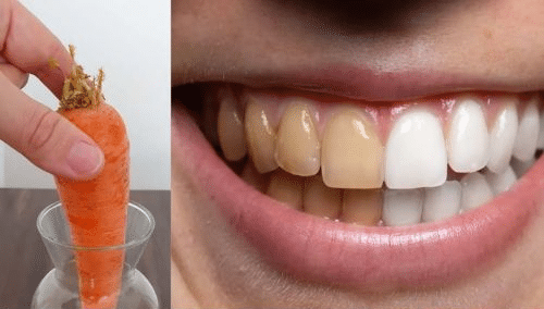 Avantages du blanchiment dentaire naturel