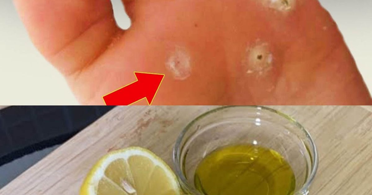 Éliminez les callosités avec ce traitement naturel