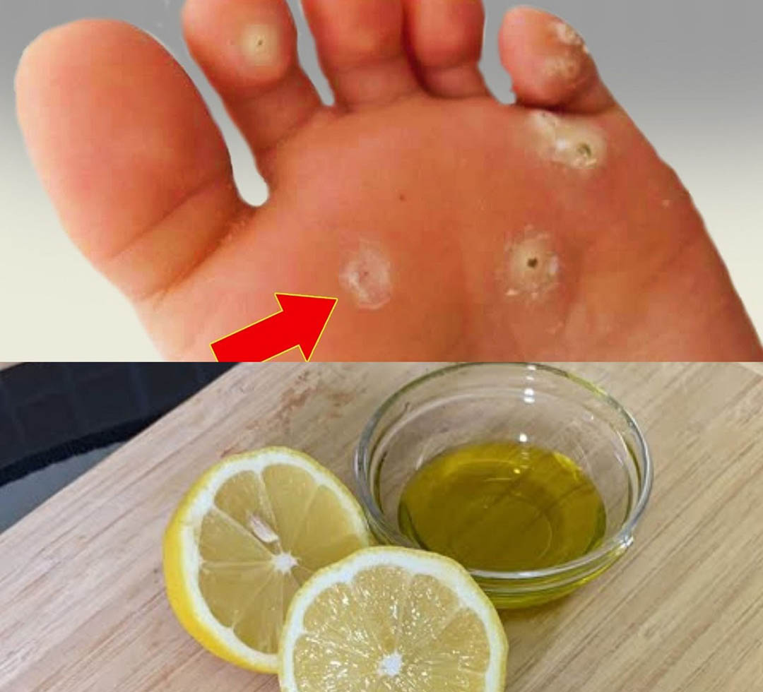 Éliminez les callosités avec ce traitement naturel