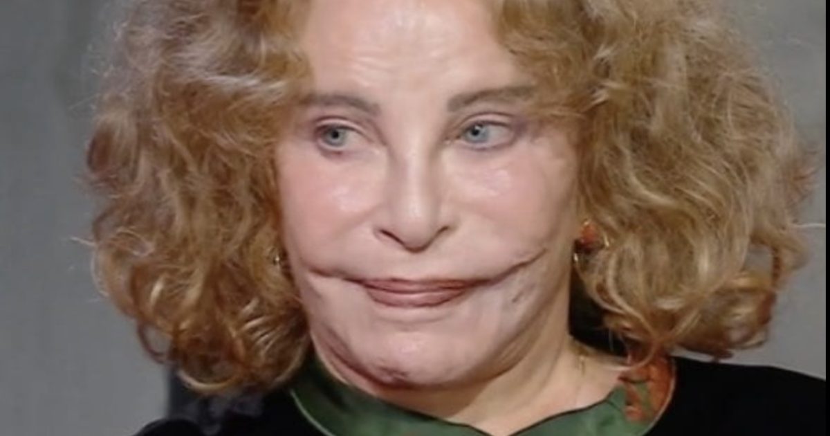 Elle était autrefois considérée comme la plus belle femme du monde, mais un tragique accident a défiguré son visage !