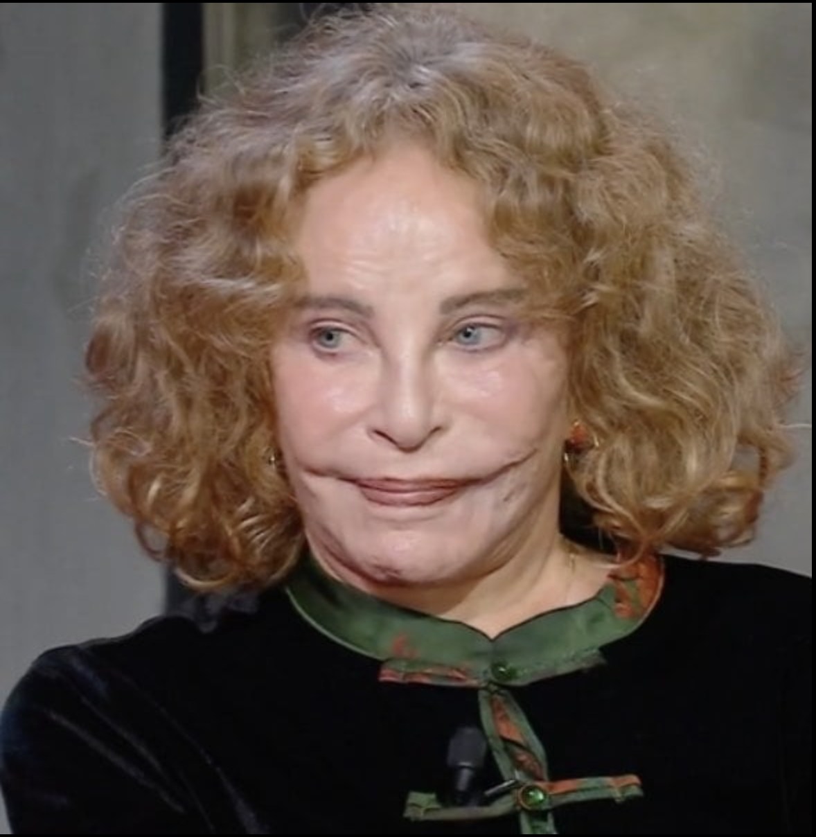 Elle était autrefois considérée comme la plus belle femme du monde, mais un tragique accident a défiguré son visage !