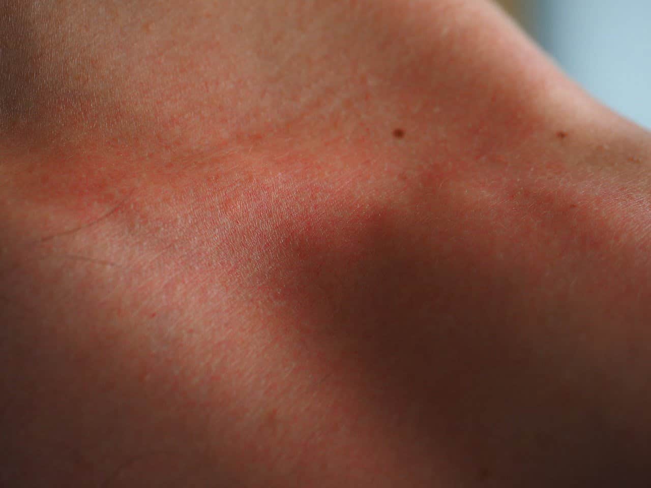 Rougeur et inflammation de la peau
