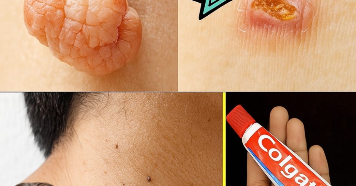 Faites disparaître verrues et acrochordons naturellement : le remède maison à 3 ingrédients que vous regretterez de ne pas avoir essayé plus tôt.