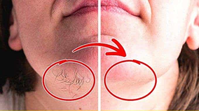 Menton : ces poules indésirables qui apparaissent avec l’âge – que faire ? Une dermatologue livre la solution la plus efficace