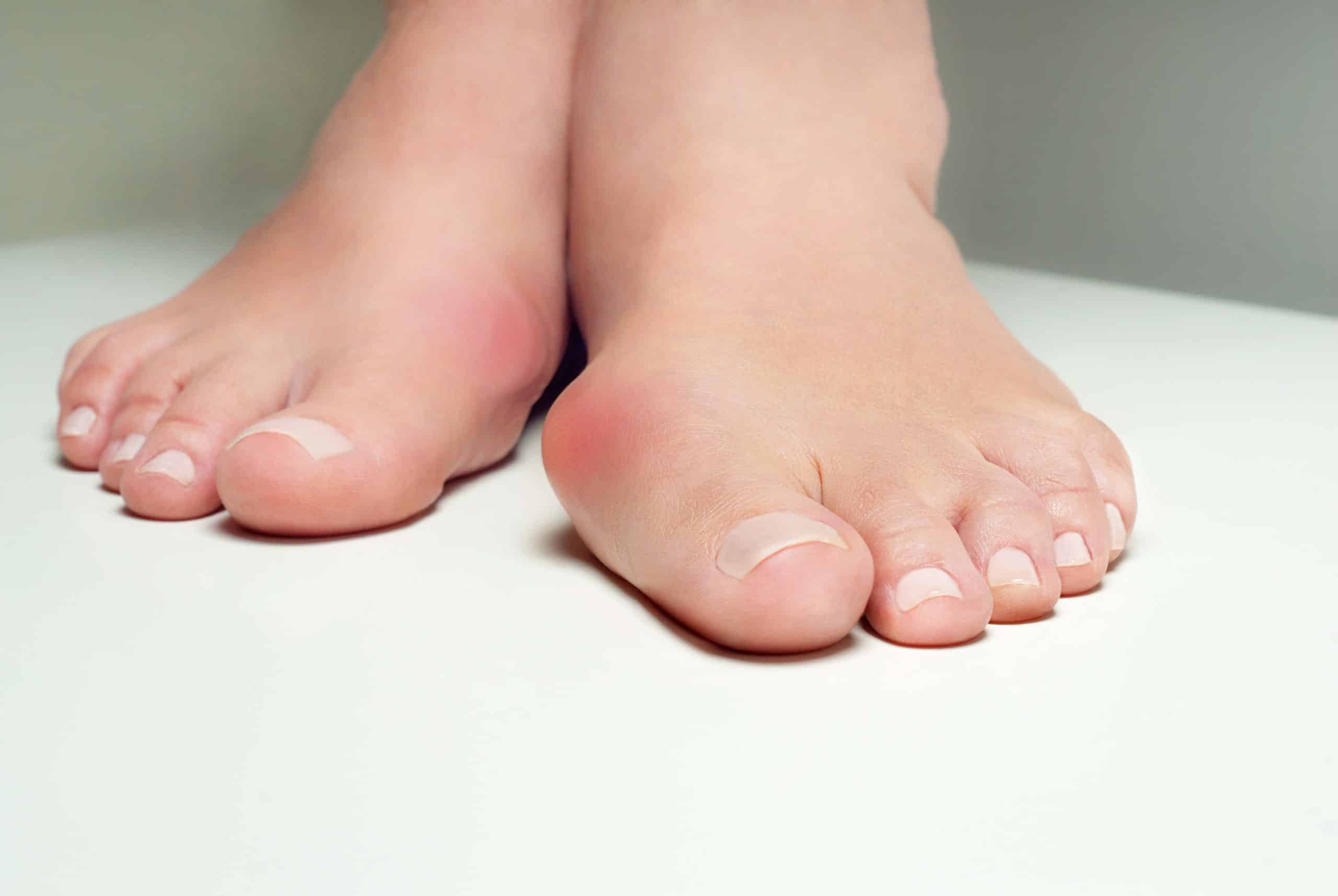 Hallux valgus - déformation du pied