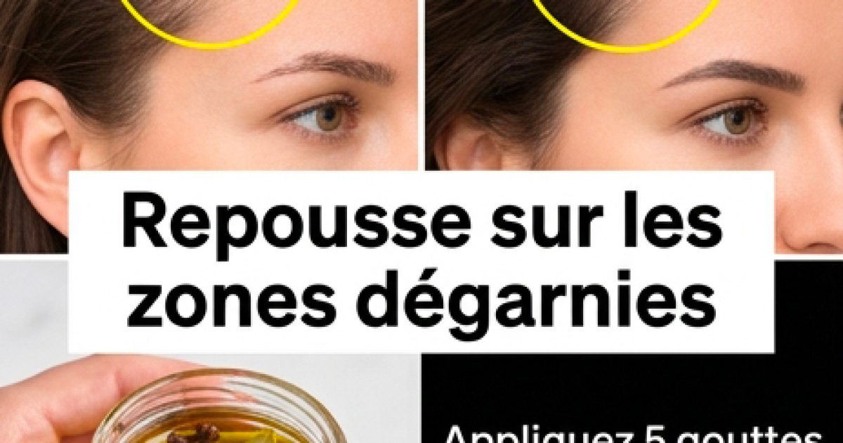 Huile de clou de girofle, romarin et laurier : faites repousser vos cheveux sur les zones dégarnies