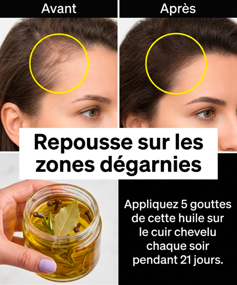 Huile de clou de girofle, romarin et laurier : faites repousser vos cheveux sur les zones dégarnies