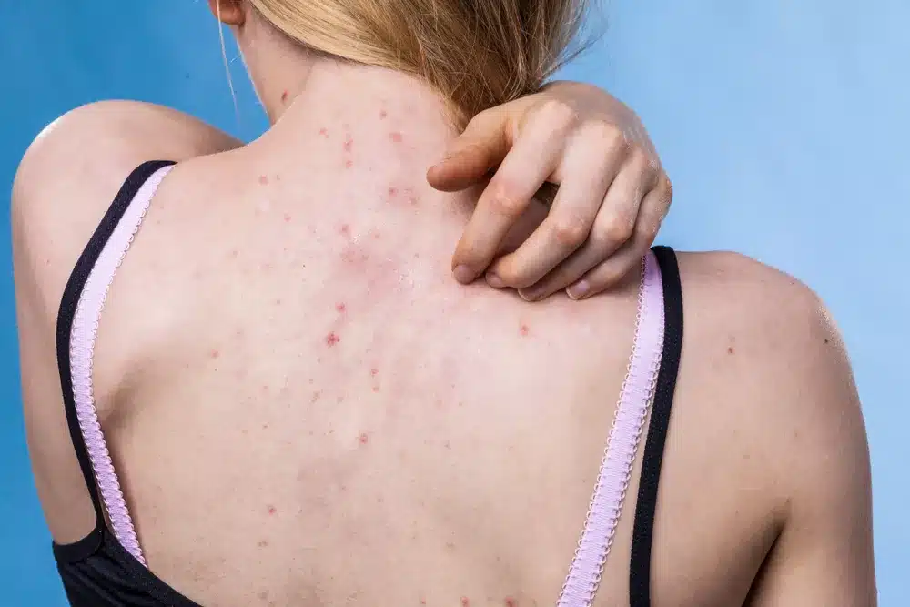 Petits points rouges sur la peau : ce que votre corps essaie vraiment de vous dire