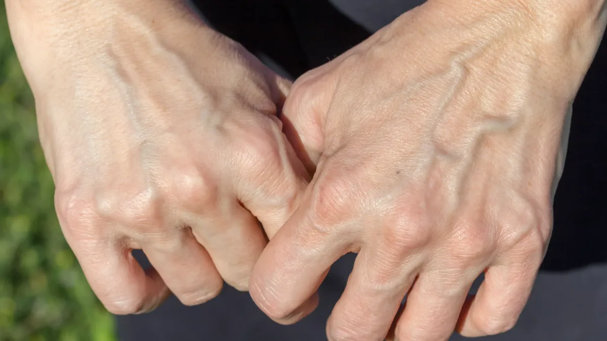 Veines apparentes : ce que votre corps révèle sans un mot