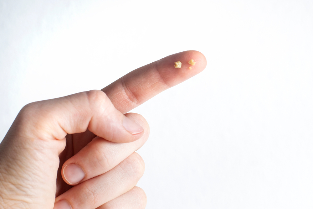 Ces mystérieuses billes blanches qui surgissent dans la gorge : que sont-elles vraiment ?