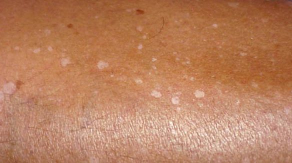 Ces taches claires sur la peau qui apparaissent après l’été : faut-il vraiment s’inquiéter ?