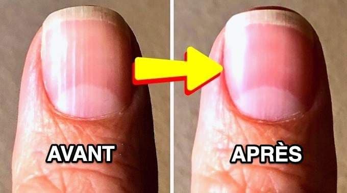 Santé : ces mystérieuses stries sur vos ongles qui en disent long sur votre corps