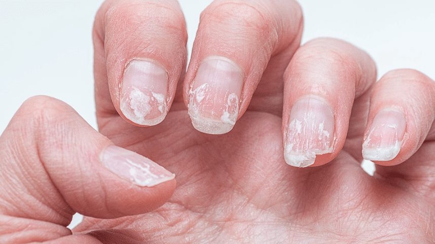 Votre santé se lit au bout des doigts : 8 indices que vos ongles vous dévoilent (et comment y remédier)