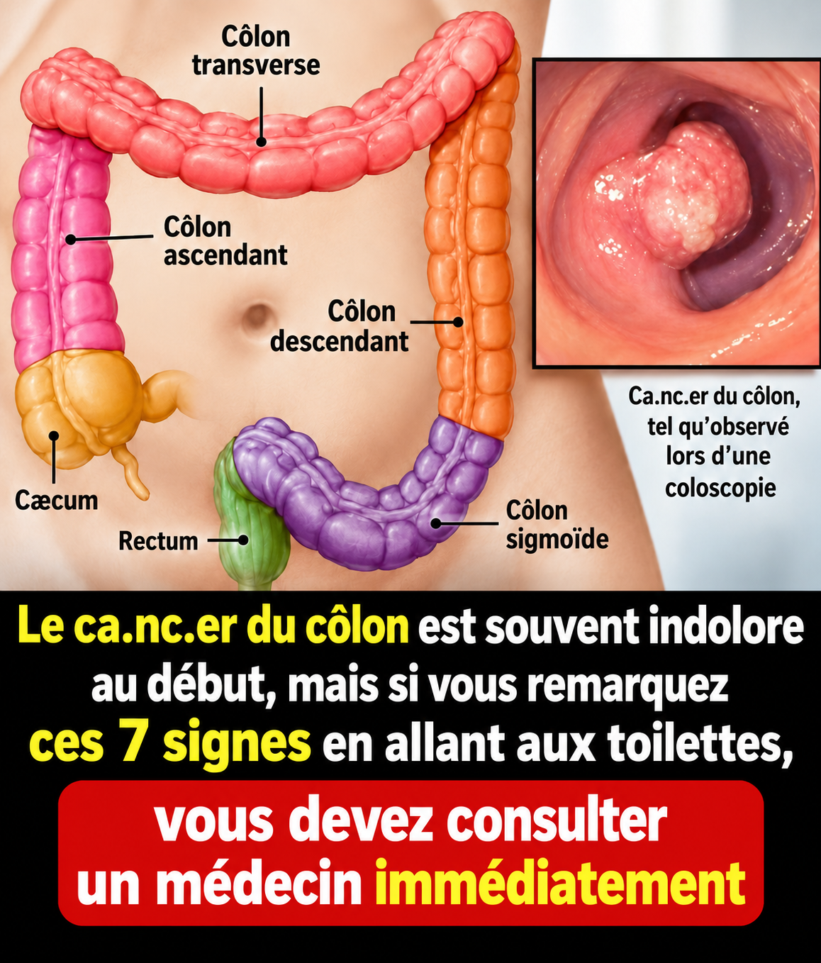 Cancer colorectal : 7 signaux que votre corps vous envoie et qu'il ne faut surtout pas ignorer