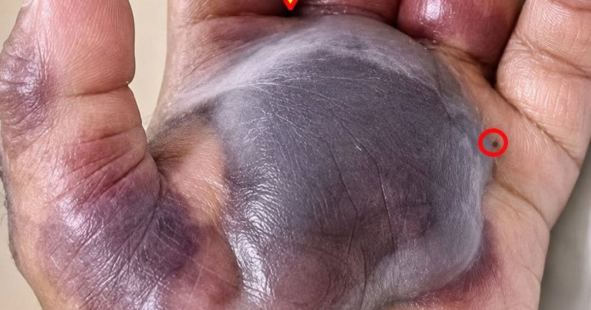 Coupure, piqûre d'insecte : les premiers signes d'infection que vous ne devriez jamais ignorer