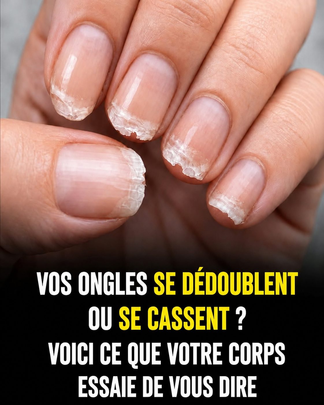 Ongles cassants ou qui se dédoublent : ce que votre corps essaie vraiment de vous dire