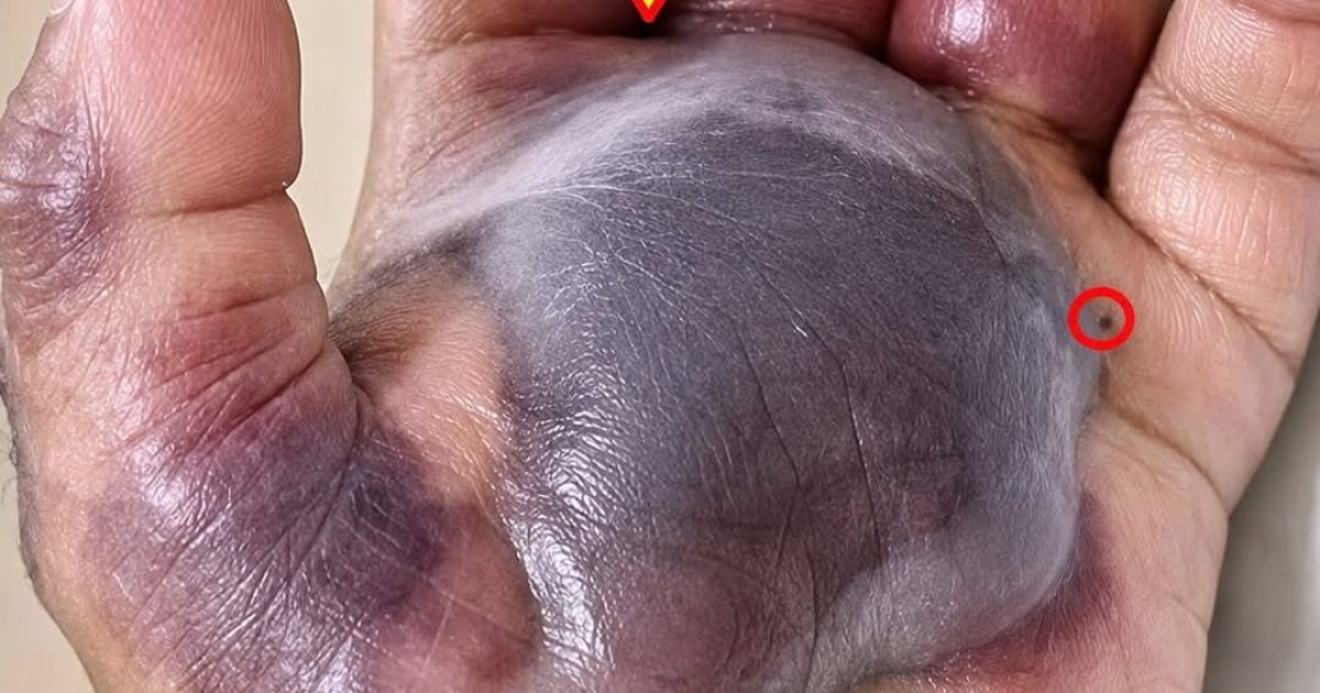 Petite coupure ou piqûre d'insecte : les signes d'infection à ne jamais ignorer