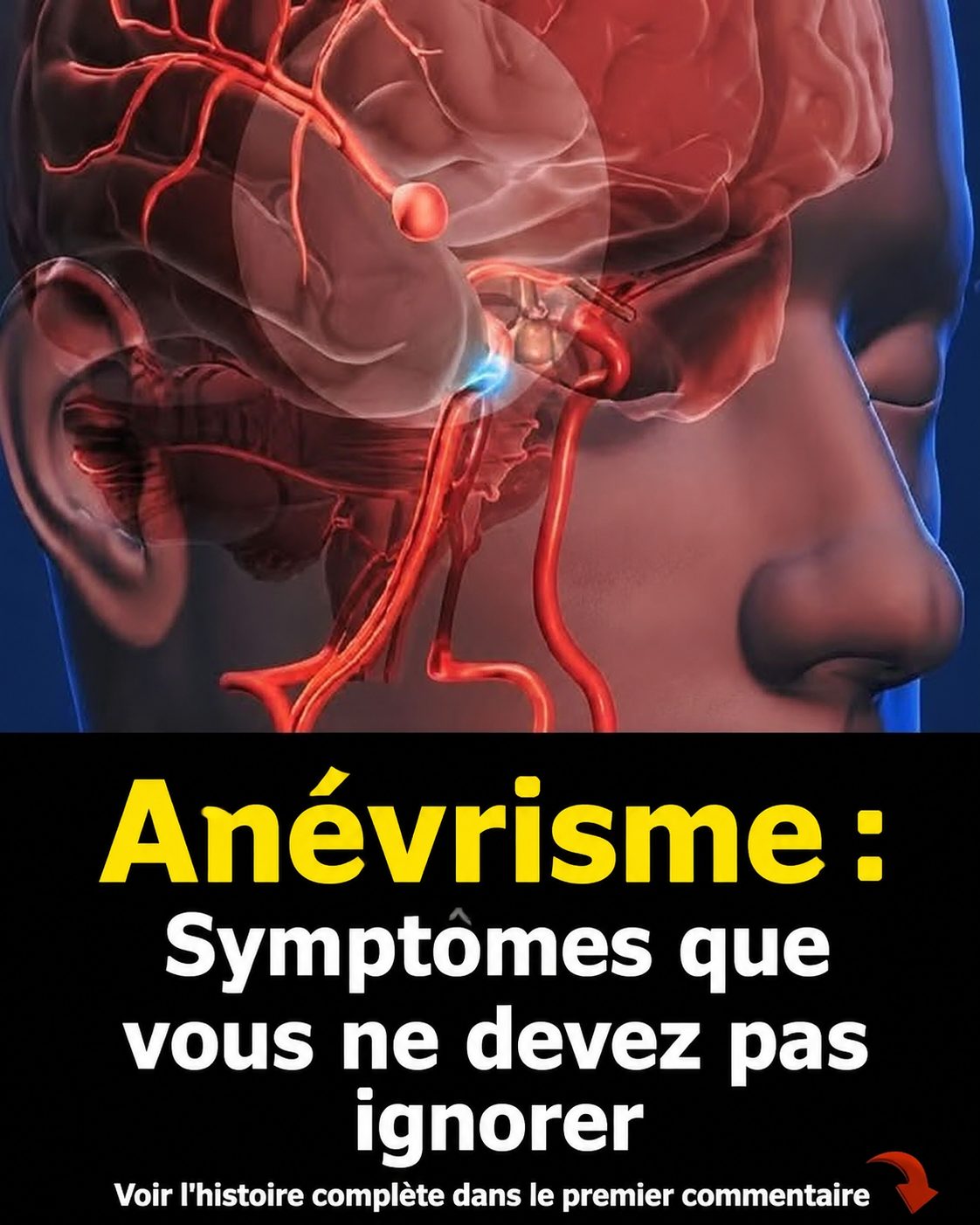Anévrisme : 12 signes d'alerte à ne surtout pas ignorer