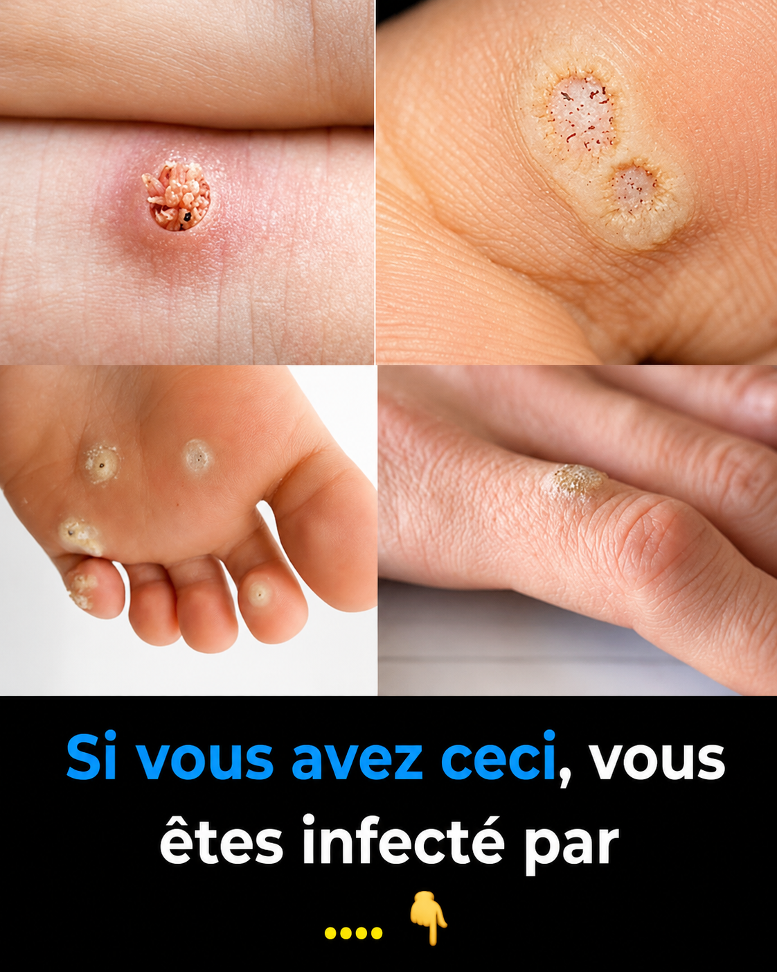 Verrues : les 6 types à reconnaître et les remèdes maison qui font vraiment la différence