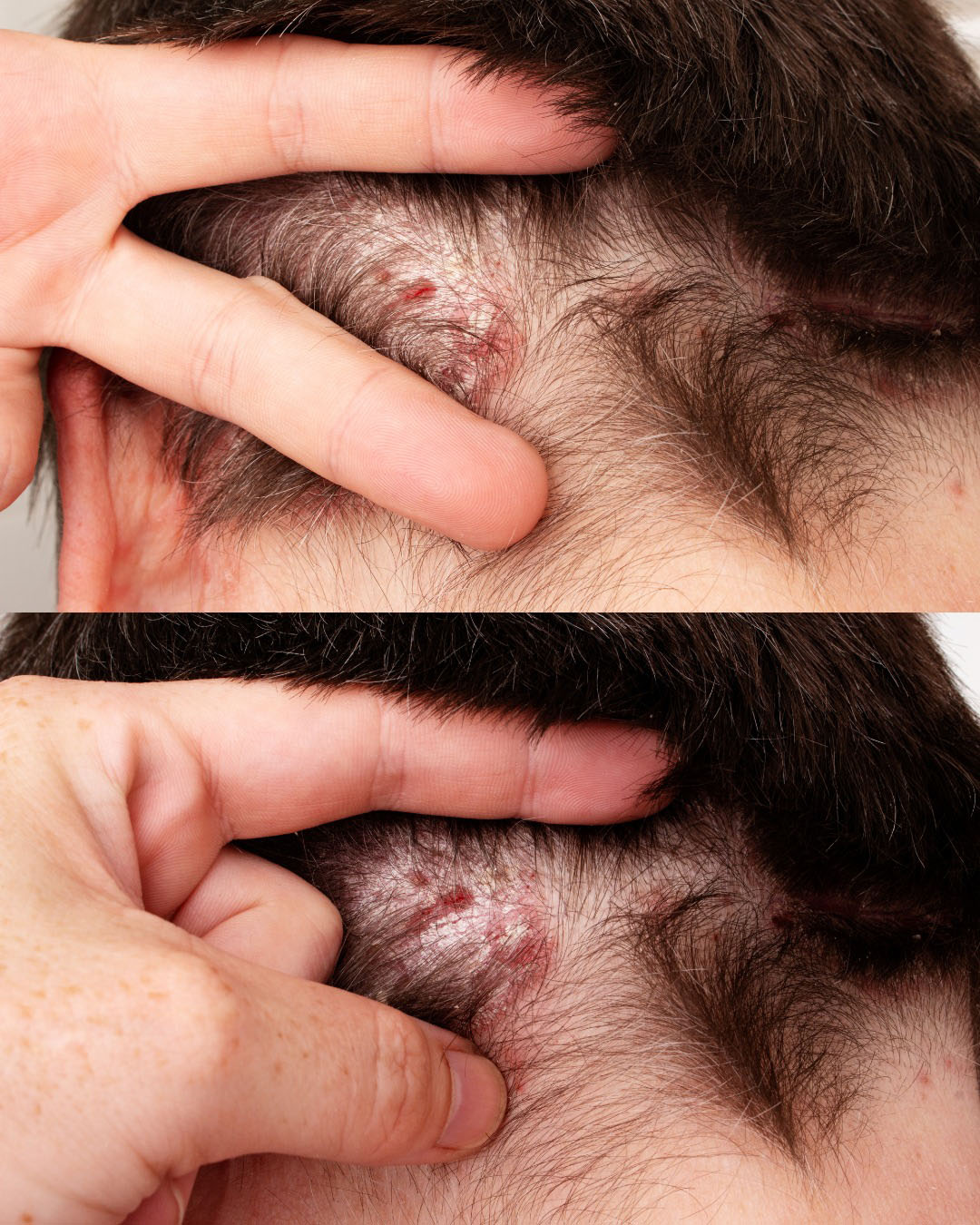 J’ai trouvé ça sur le cuir chevelu de mon fils. Je n’ai aucune idée de ce que c’est, et on ne peut pas avoir de rendez-vous chez le médecin rapidement. Des conseils ?