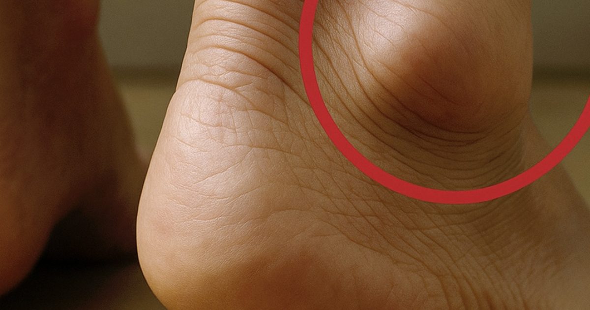 Jambes enflées : comprendre les symptômes, les causes et les traitements