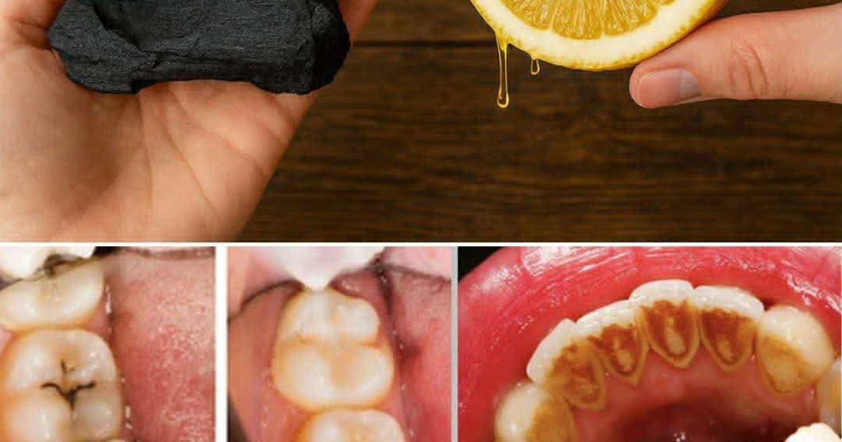 Jus de citron & charbon actif : les secrets naturels pour des dents saines