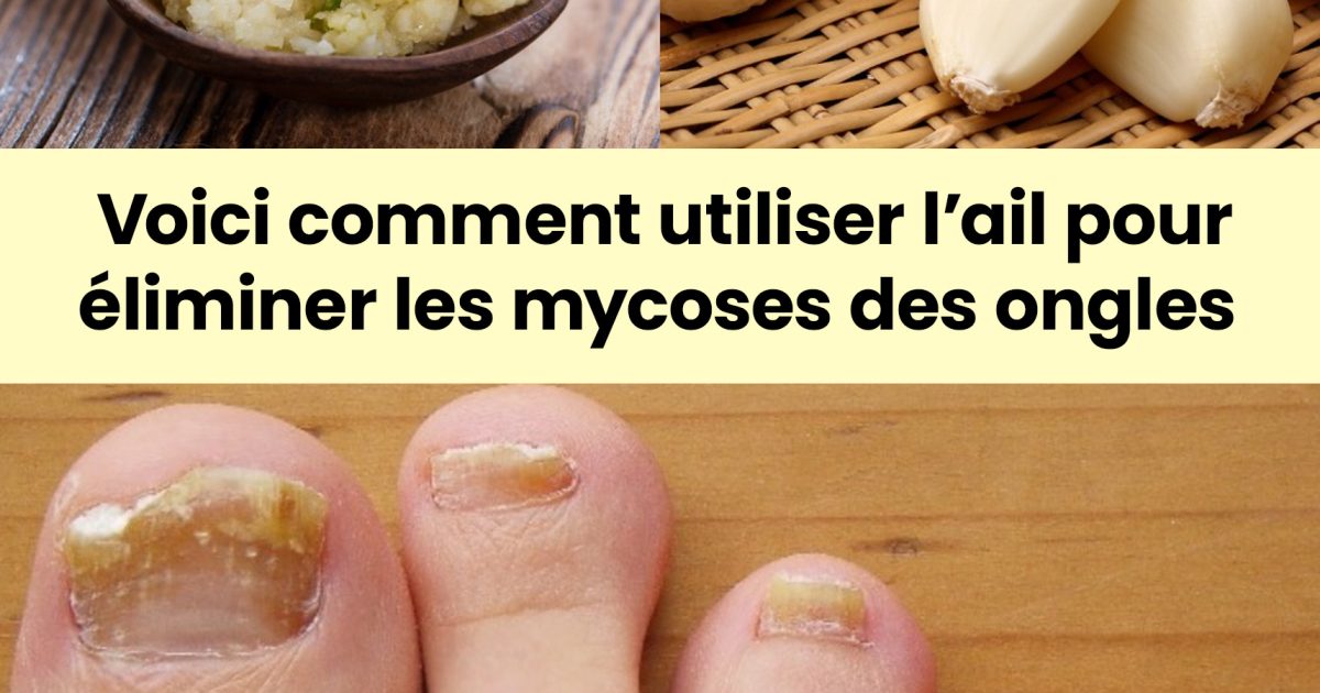 L’ail : un remède naturel contre les mycoses