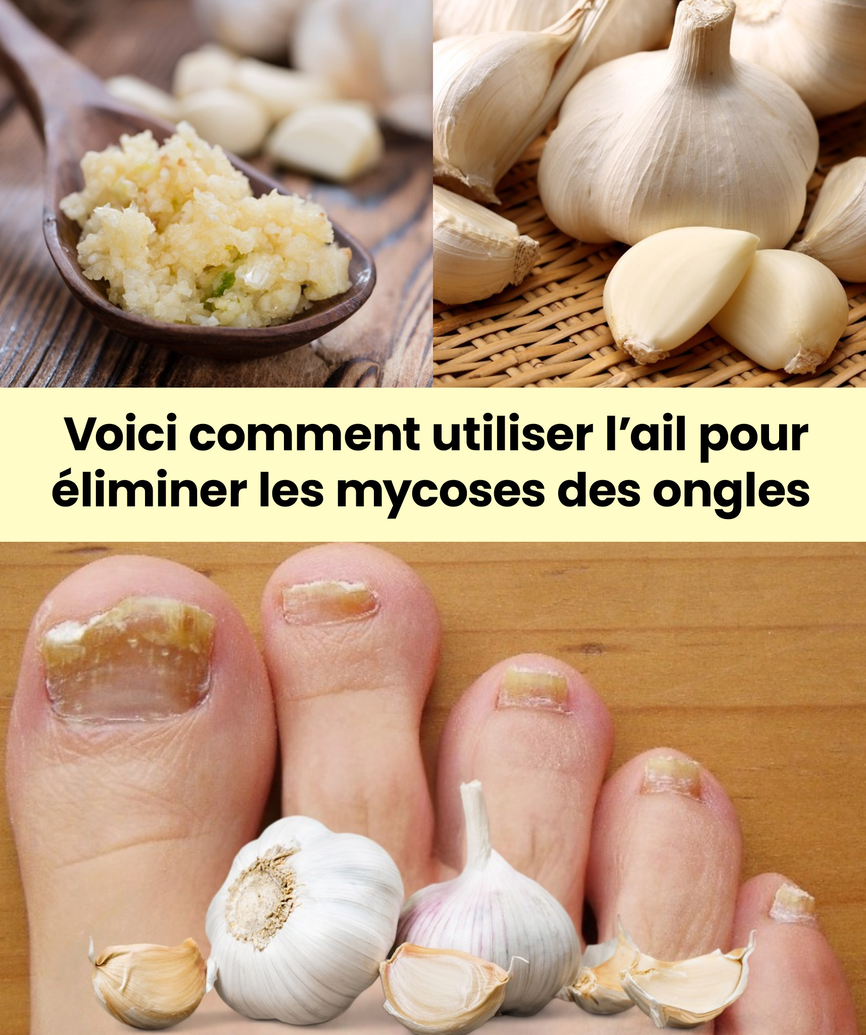 L’ail : un remède naturel contre les mycoses
